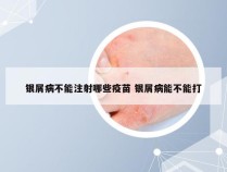 银屑病不能注射哪些疫苗 银屑病能不能打