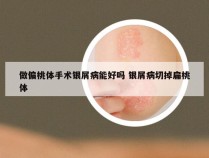 做偏桃体手术银屑病能好吗 银屑病切掉扁桃体