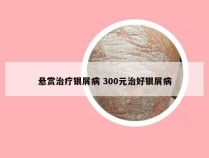 悬赏治疗银屑病 300元治好银屑病