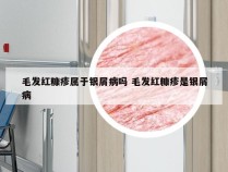 毛发红糠疹属于银屑病吗 毛发红糠疹是银屑病