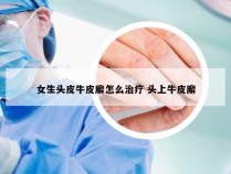 女生头皮牛皮廨怎么治疗 头上牛皮廨