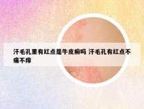 汗毛孔里有红点是牛皮癣吗 汗毛孔有红点不痛不痒