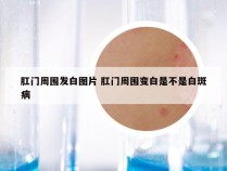 肛门周围发白图片 肛门周围变白是不是白斑病