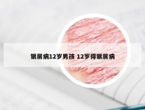 银屑病12岁男孩 12岁得银屑病