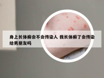 身上长体癣会不会传染人 我长体癣了会传染给男朋友吗