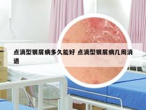 点滴型银屑病多久能好 点滴型银屑病几周消退