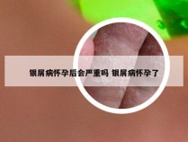 银屑病怀孕后会严重吗 银屑病怀孕了