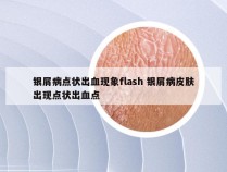 银屑病点状出血现象flash 银屑病皮肤出现点状出血点