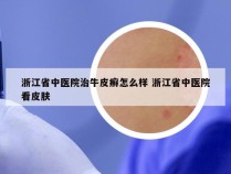 浙江省中医院治牛皮癣怎么样 浙江省中医院看皮肤