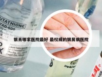 银肖哪家医院最好 最权威的银屑病医院