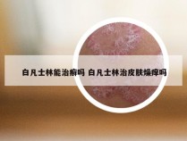 白凡士林能治癣吗 白凡士林治皮肤燥痒吗