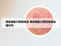 银屑病能打新冠疫苗 银屑病能打新冠疫苗加强针吗