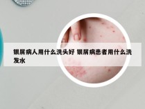 银屑病人用什么洗头好 银屑病患者用什么洗发水