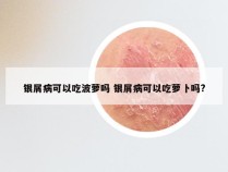 银屑病可以吃波萝吗 银屑病可以吃萝卜吗?