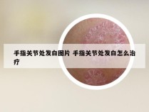 手指关节处发白图片 手指关节处发白怎么治疗