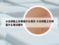 小女孩腿上长癣是什么情况 小女孩腿上长癣是什么情况图片