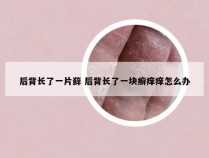 后背长了一片藓 后背长了一块癣痒痒怎么办