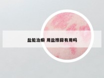 盐能治癣 用盐擦藓有用吗