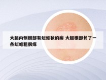 大腿内侧根部有蚯蚓状的癣 大腿根部长了一条蚯蚓粗很痒