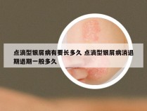 点滴型银屑病有要长多久 点滴型银屑病消退期退期一般多久