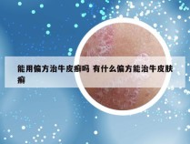 能用偏方治牛皮癣吗 有什么偏方能治牛皮肤癣