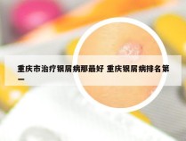 重庆市治疗银屑病那最好 重庆银屑病排名第一