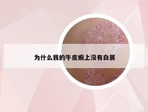 为什么我的牛皮癣上没有白屑