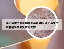 头上寻常型银屑病冬季会复发吗 头上寻常型银屑病冬季会复发吗女性