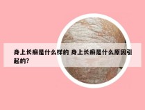 身上长癣是什么样的 身上长癣是什么原因引起的?