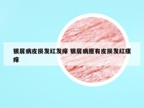 银屑病皮损发红发痒 银屑病原有皮损发红瘙痒