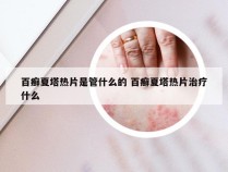 百癣夏塔热片是管什么的 百癣夏塔热片治疗什么