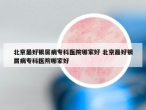 北京最好银屑病专科医院哪家好 北京最好银屑病专科医院哪家好