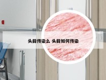 头藓传染么 头藓如何传染