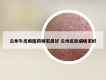 兰州牛皮癣医院哪家最好 兰州皮肤病哪家好