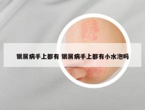 银屑病手上都有 银屑病手上都有小水泡吗