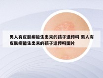 男人有皮肤癣能生出来的孩子遗传吗 男人有皮肤癣能生出来的孩子遗传吗图片