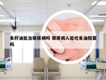 鱼肝油能治银屑病吗 银屑病人能吃鱼油胶囊吗