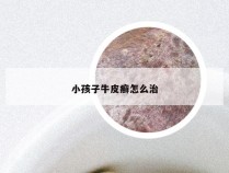 小孩子牛皮癣怎么治