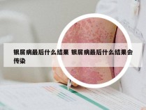 银屑病最后什么结果 银屑病最后什么结果会传染