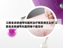 江西省皮肤病专科医院治疗银屑病怎么样 江西省皮肤病专科医院哪个医生好