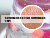 银屑病图片与玫瑰糠疹很像 银屑病和玫瑰糠疹图片