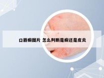 口唇癣图片 怎么判断是癣还是皮炎