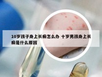 10岁孩子身上长癣怎么办 十岁男孩身上长癣是什么原因