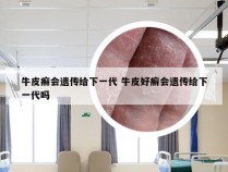 牛皮癣会遗传给下一代 牛皮好癣会遗传给下一代吗