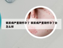 银屑病严重期怀孕了 银屑病严重期怀孕了会怎么样