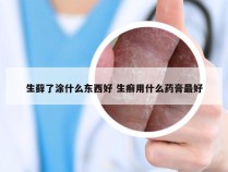 生藓了涂什么东西好 生癣用什么药膏最好