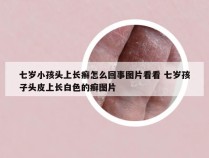 七岁小孩头上长癣怎么回事图片看看 七岁孩子头皮上长白色的癣图片