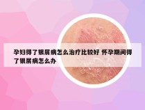 孕妇得了银屑病怎么治疗比较好 怀孕期间得了银屑病怎么办