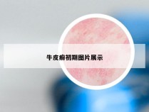 牛皮癣初期图片展示