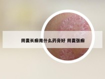 阴囊长癣用什么药膏好 阴囊张癣